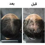 شامپو ضد ریزش فیتو زنانه و مردانه - Image 5