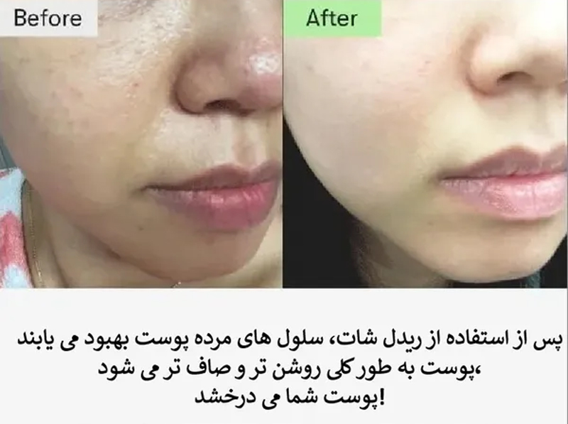 خرید سرم میکرونیدلینگ ریدل شات دوز 300