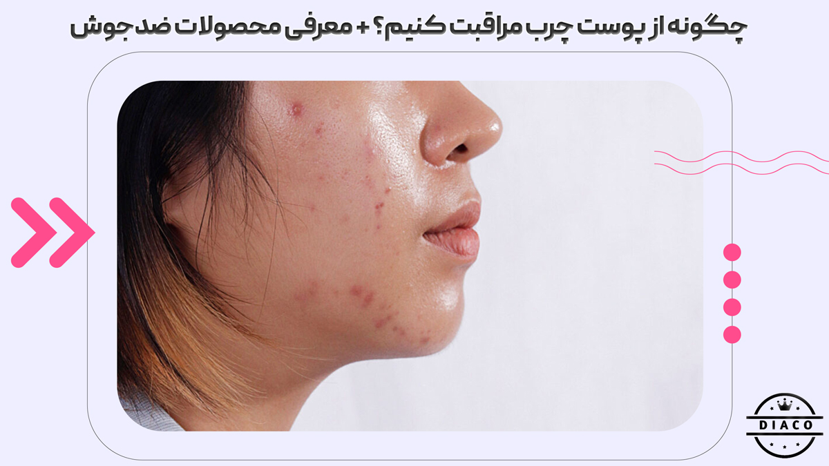 چگونه از پوست چرب مراقبت کنیم؟ معرفی راهکارهای موثر و محصولات ضدجوش